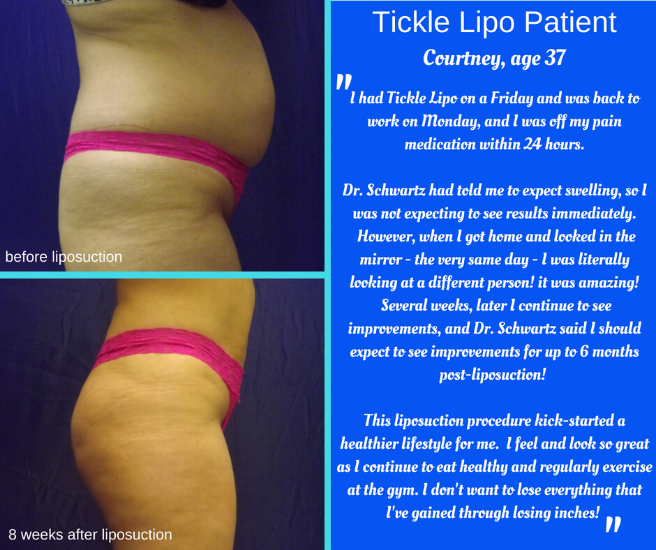Tampa Liposuction Specialty Clinic