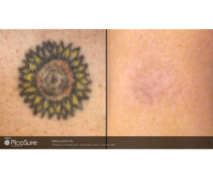 Does Tattoo Removal Hurt? | Kansas City Laser Tattoo Removal | Premier Vein  and Body by Schwartz