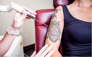 Choosing the Best Type of Laser Tattoo Removal | Kansas City Laser Tattoo  Removal | Premier Vein and Body by Schwartz