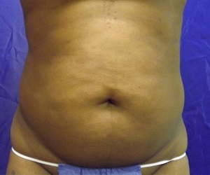 Before-liposuction