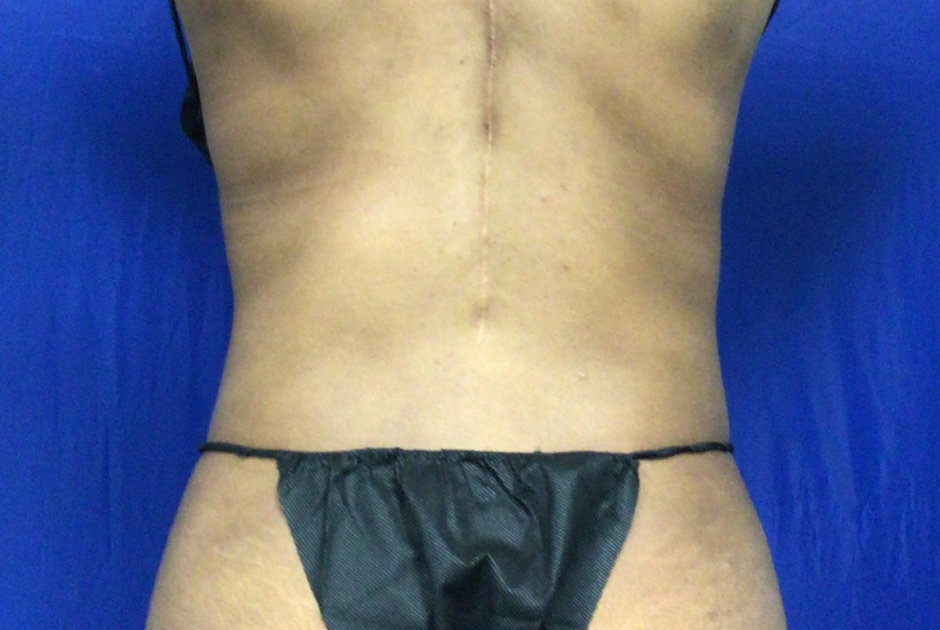 38-year-old patient had liposuction to the lower and upper abdomen, flanks, and bra line. After photo was taken 1-year post-procedure.
