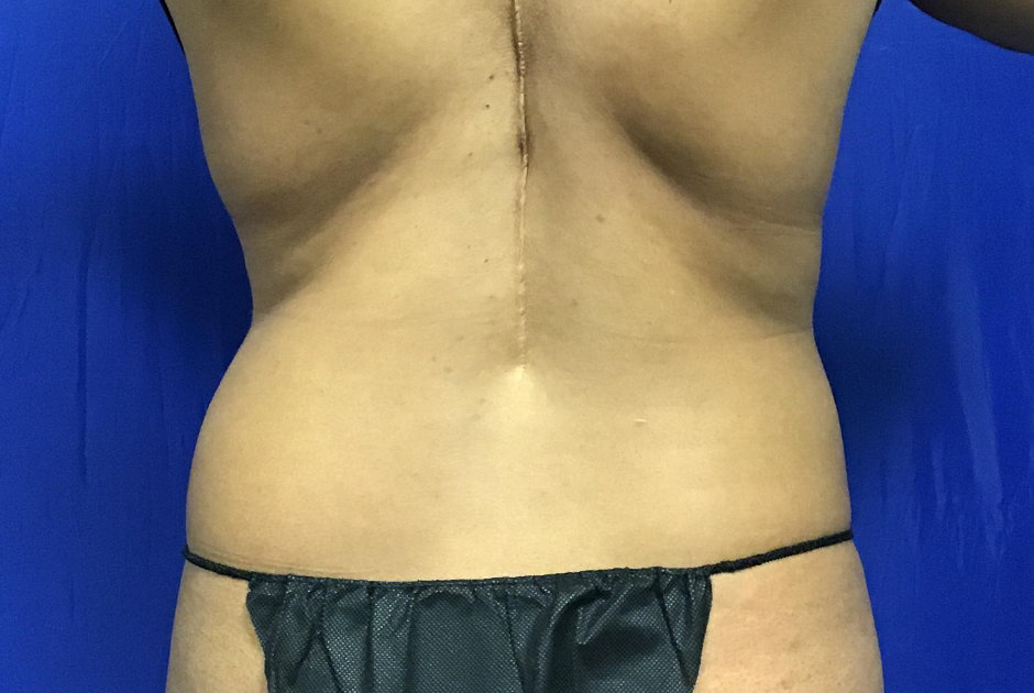 38-year-old patient had liposuction to the lower and upper abdomen, flanks, and bra line. After photo was taken 1-year post-procedure.